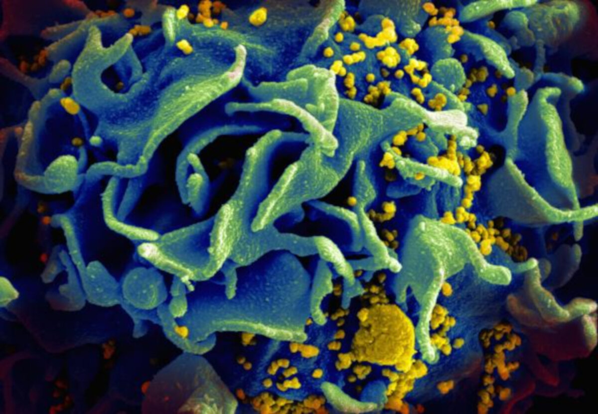 Dubbla virus bromsar utveckling av AIDS – Vetenskap och Hälsa