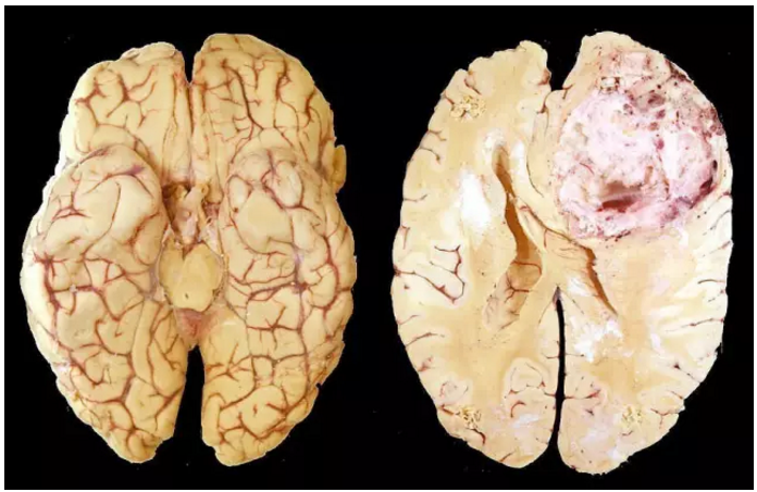 胶质母细胞瘤患者的脑组织