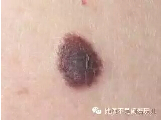 复合痣