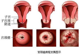 从女性的视角看宫颈癌疫苗