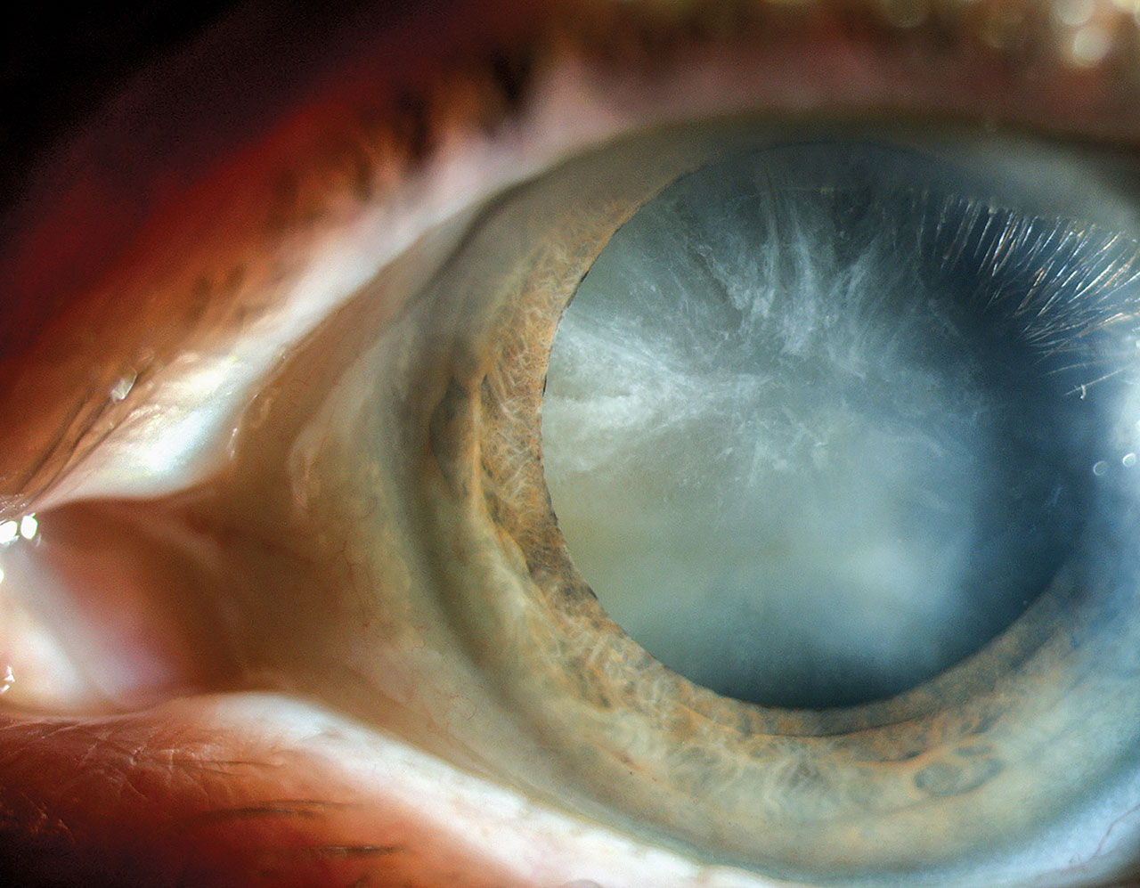 双眼白内障合并先天性晶状体缺损一例 - 中华眼科杂志