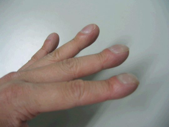 AJHG:中国科学家找到杵状指又一致病基因SL