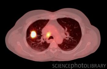 非小细胞肺癌 ct/pet 扫描照