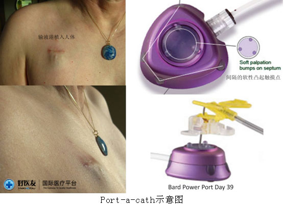 4Port-a-cath示意图.jpg