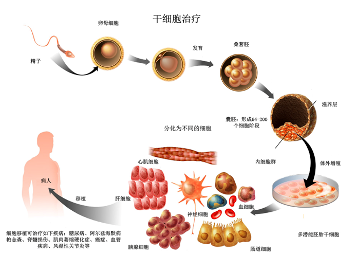 干细胞治疗糖尿病