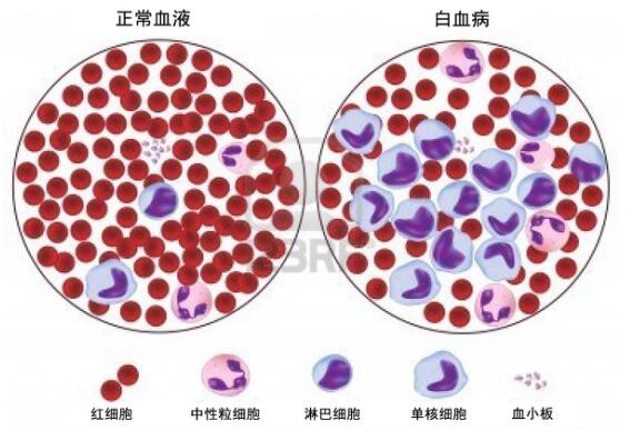 什么是急性白血病？