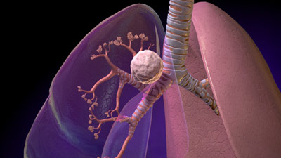 Nat.Med.：日美研究小组发现引发肺腺癌的异常基因