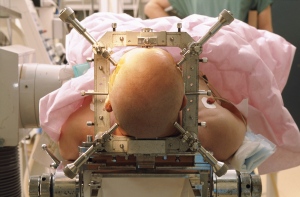 Arch Gen Psychiatry:深部脑刺激对抑郁症有长期疗效