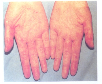 我国科学家找到治疗系统性红斑狼疮"新钥匙"