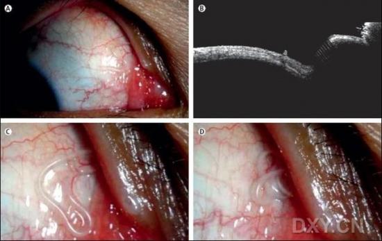 图A：患者右眼鼻侧上睑处的结膜上可见蠕虫；图B：眼前节光学相干断层扫描；图C，D：再发现2条爬行的蠕虫