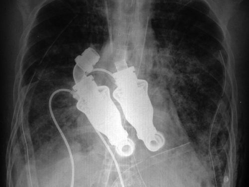 取代心脏的离心泵是一个类似涡轮的装置,装有结构简单的涡动转子。