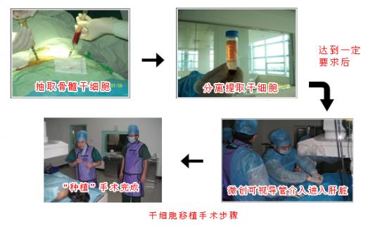 干细胞移植技术的原理如下：