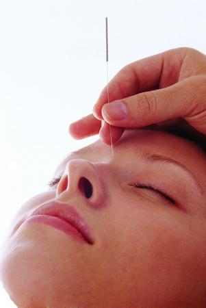 针灸治头痛