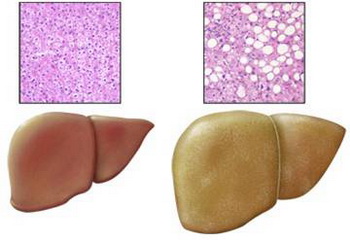 脂肪肝 不增加死亡风险