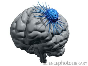 脑癌细胞增添“新影子”　