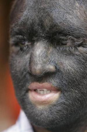 毛人”秘密：染色体异常所致