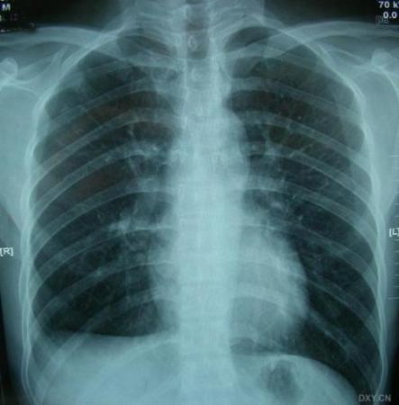 新方法可快速廉价诊断肺结核
