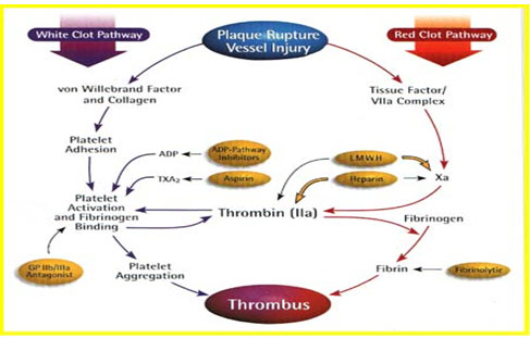 急性冠脉综合征成因