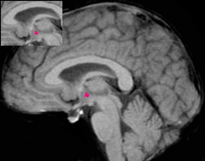 用磁共振 “看清”肥胖