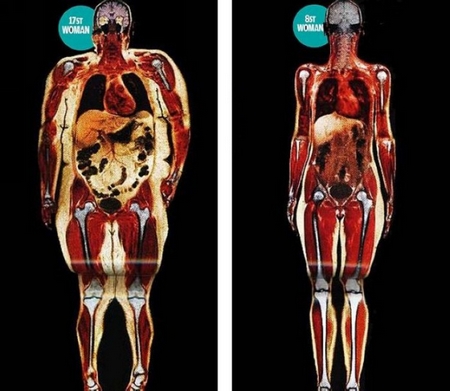 用磁共振 “看清”肥胖