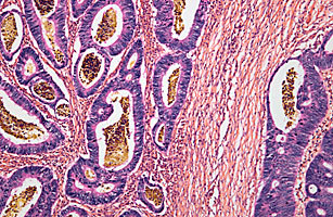 细菌和结肠癌之间的神秘关联