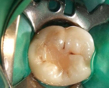 dental research:人体干细胞成功造出人工牙齿