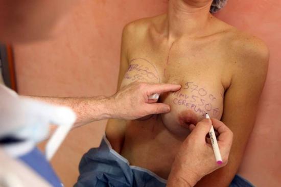 法国三万女性隆胸硅胶之痛 工业硅胶要不得