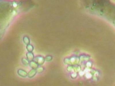 肺部的囊性纤维化图