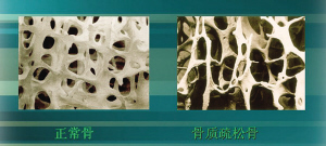 正常骨(左)骨质疏松骨