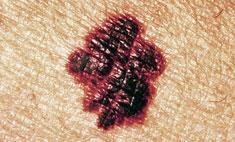 Genetics Of Melanoma Chemoresistance