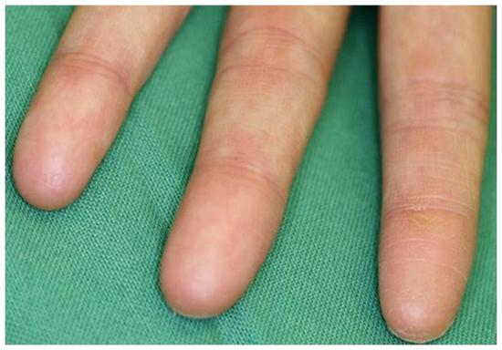 研究人员揭示了导致患者没有指纹的一种罕见疾病背后的突变