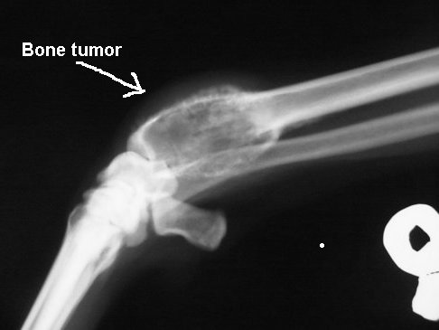 Bone tumor