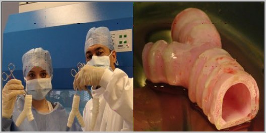 科学家为病人更换了全新的人工气管