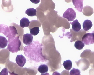 异常骨髓象-慢性淋巴细胞白血病