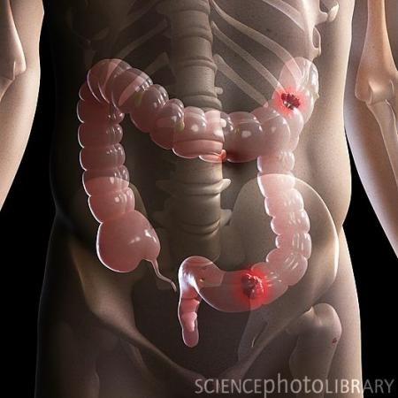 防癌早知道——警惕癌症发生的早期征兆 大肠癌