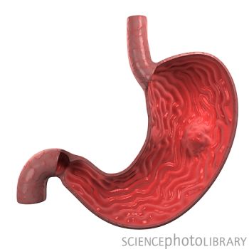 防癌早知道——警惕癌症发生的早期征兆 胃癌