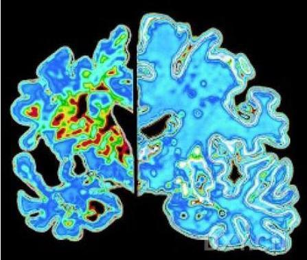 Science:蓓萨罗丁有助治疗阿尔茨海默氏症