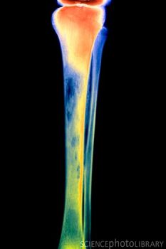 金黄色葡萄球菌性骨髓炎