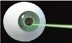 手术首先利用飞秒雷射将角膜瓣分开