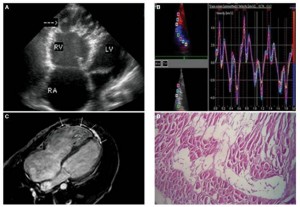 致心律失常型右室心肌病 (A) 经胸壁超声心动图示四腔心,可见右心室扩张及右室心尖部膨出的室壁瘤,伴多发间隔(箭头所示)(B) 组织多普勒速度曲线示收缩期及舒张早期速度减慢,底-中-尖梯度消失(base-mid-apex gradient) (C)MRI心脏长轴图像示右室壁和左室心尖部广泛增强的脂肪信号(箭头所示)(D) 右室壁组织切片染色示心肌细胞被纤维脂肪组织替代(H-E, x100).