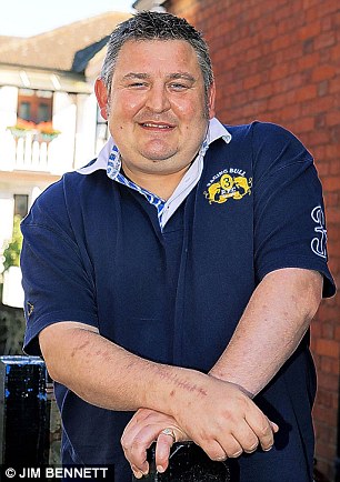 蒂姆•阿波理斯彼展示手腕手术后留下的疤痕