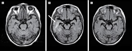 Magnetic resonance imaging (MRI) scans from an APOE 4 homozygous patient. Images shown represent scans at baseline (A), during treatment (B), and after treatment (C) that were acquired using a fluid-attenuated inversion recovery sequence. The new area of hyperintensity on the scan performed during treatment (B) is most prominent in the right temporal lobe (arrow) and is consistent with inflammation or vasogenic edema. It first appeared on the scheduled MRI scan 2 weeks after the second drug infusion, was progressive for 6 weeks, and subsequently spontaneously completely resolved by week 17 (C). 