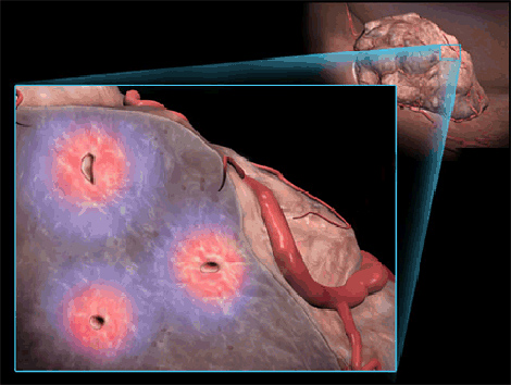 肿瘤细胞缺氧使其更容易扩散