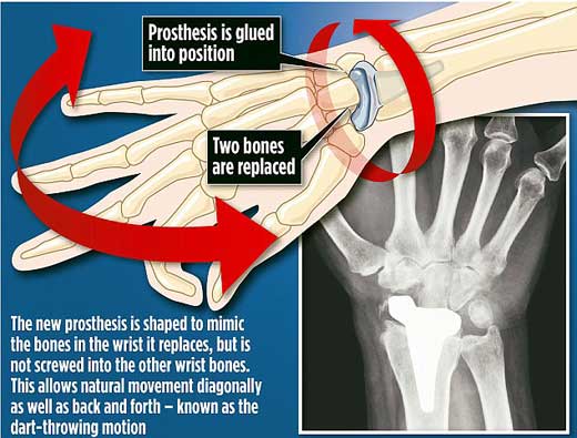 腕骨置换手术示意图