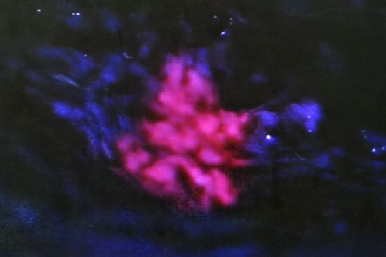 肺癌易复发原因 刺猬蛋白