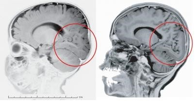 On the left, the occipital region of a normal human brain is circled. On the right, the same area of the brain of a subject with mutation of LAMC3 gene is smooth, and lacks normal folds and convolutions.