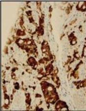 Expression of CDK6 gene in patient tissue. 