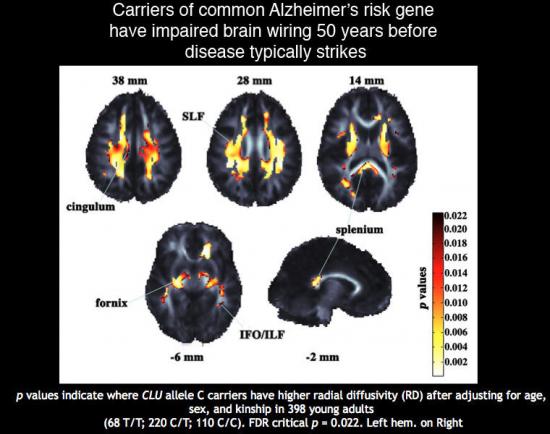 CLU: Carriers of a common Alzheimer's risk gene have impaired brain wiring, shown here, 50 years before disease typically strikes.
