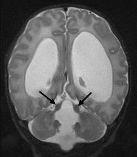 Cell：研究识别出JS等疾病相关基因