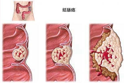 PLoS ONE：结肠癌发生致病因素研究获进展